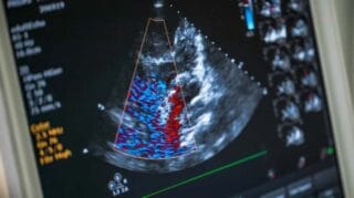 اکوکاردیوگرافی