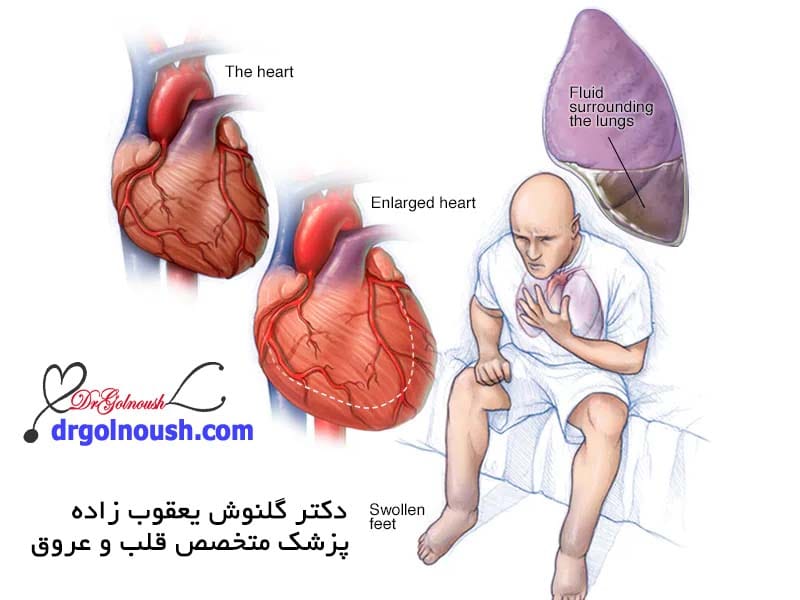 heart-failure.jpg