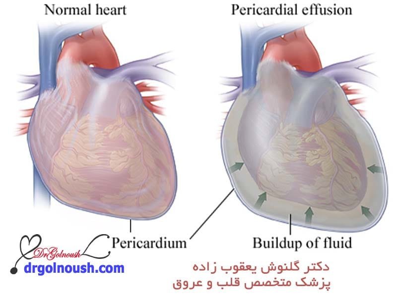 -پرده-دور-قلب-یا-پریکاردیت.jpg
