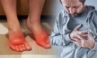 ورم پا در بیماران قلبی